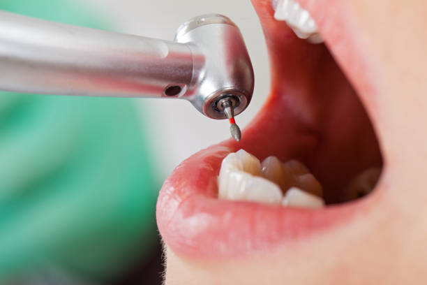 Best Chipped Tooth Repair Near Me  in Laurel Hill, NC